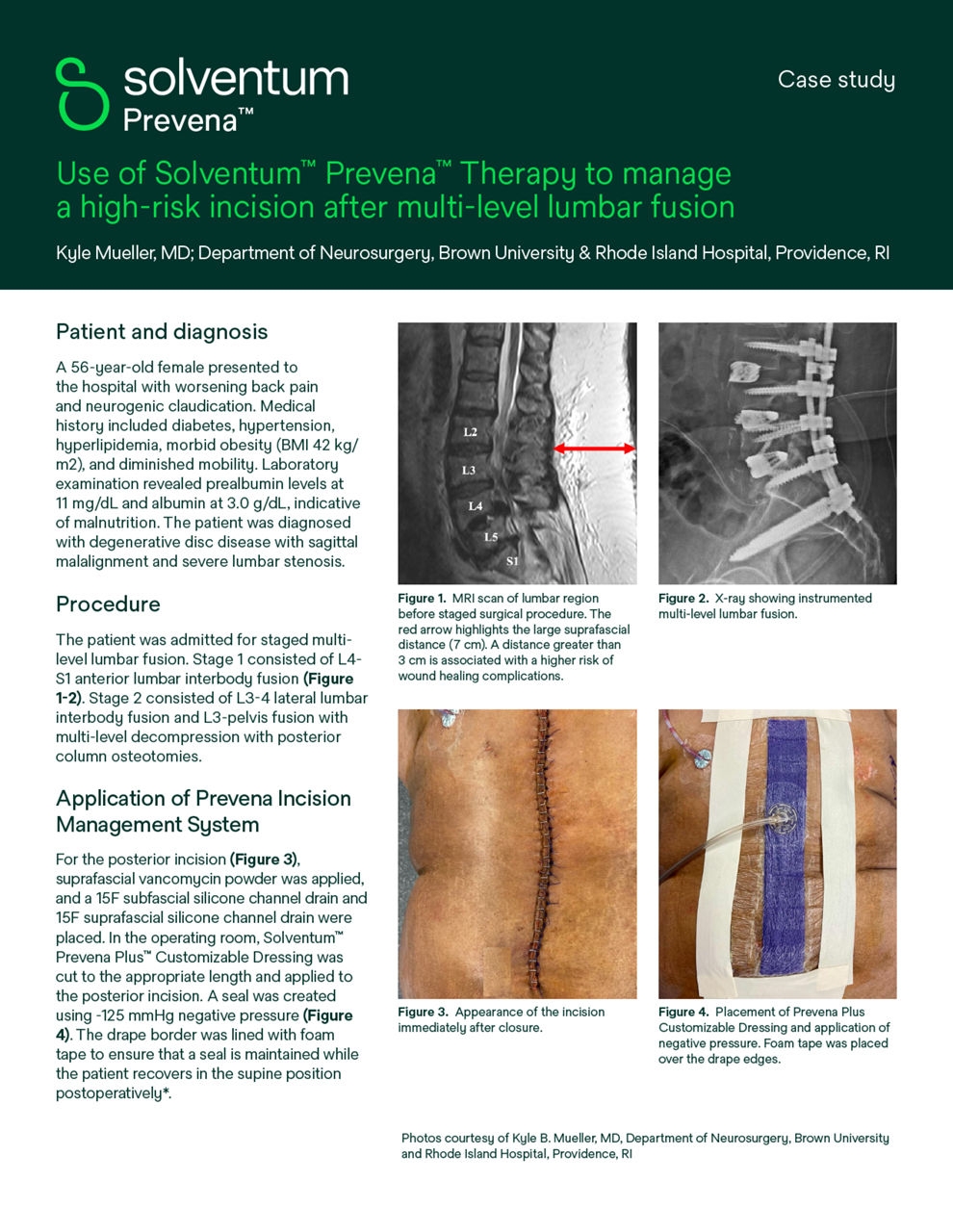 3M Prevena Therapy For Spine Surgery Solventum